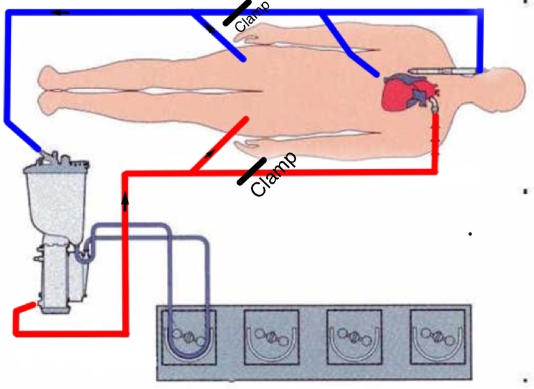 Pulmonary Valve Replacement in Adult Congenital Cardiac